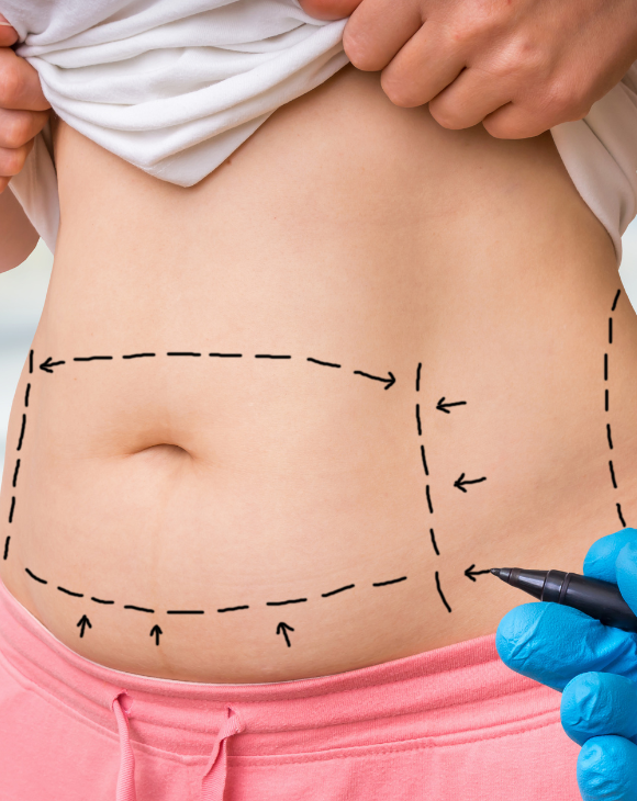 A plastic surgeon carefully marking the areas for a tummy lift procedure on a patient's body with a pen.